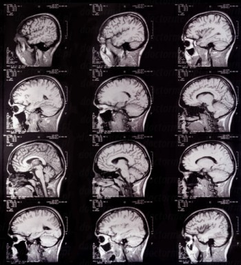 МРТ снимок головного мозга