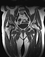 МРТ снимок тазобедренного сустава
