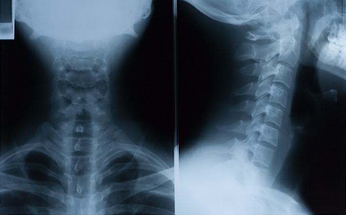 рентген шейного отдела позвоночника